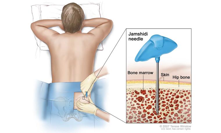 Saiba da importância do transplante de medula óssea