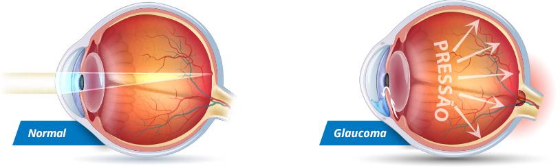 Dia Nacional de Combate ao Glaucoma - 26 de maio