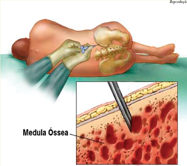 Transplante de medula óssea