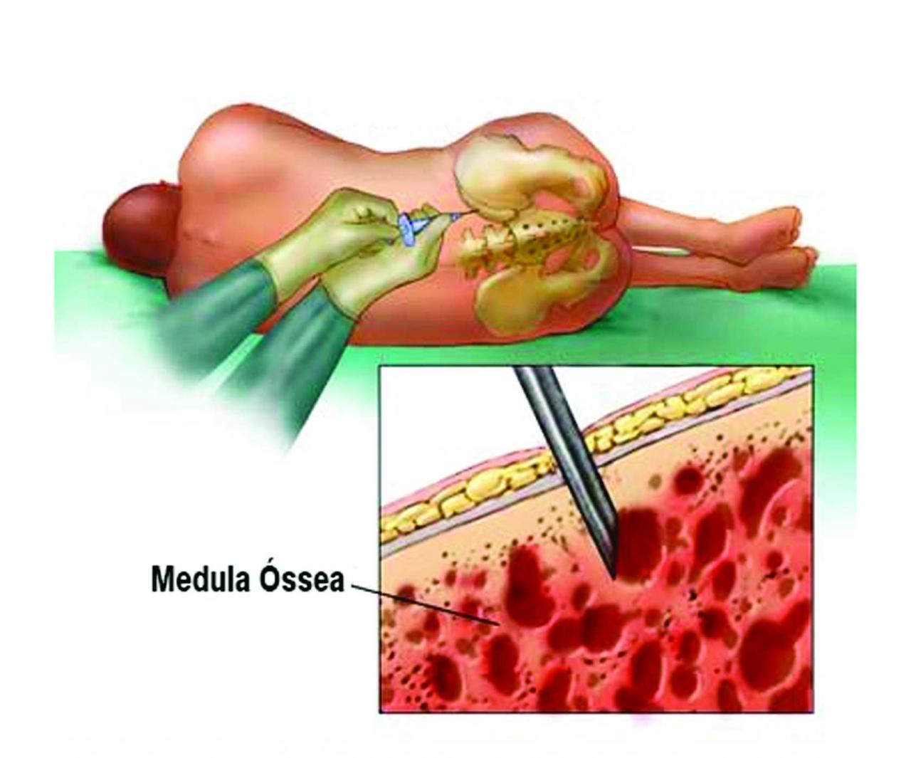 Transplante de medula óssea