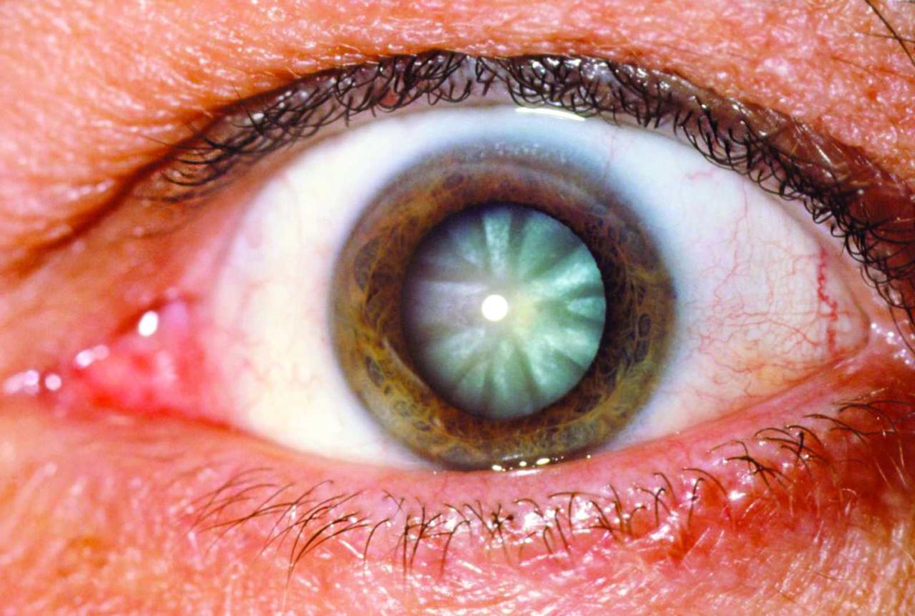 Dia Nacional de Combate ao Glaucoma
