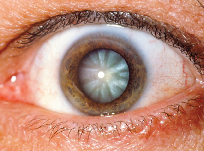 Dia Nacional de Combate ao Glaucoma 