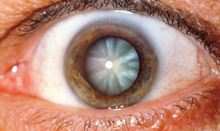 Dia Nacional de Combate ao Glaucoma 